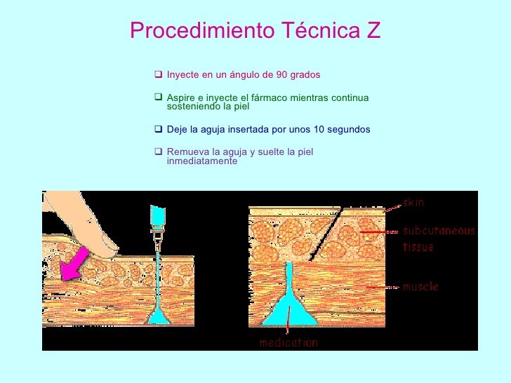 Tecnica De Z Para Inyectar Hierro es.slideshare.net