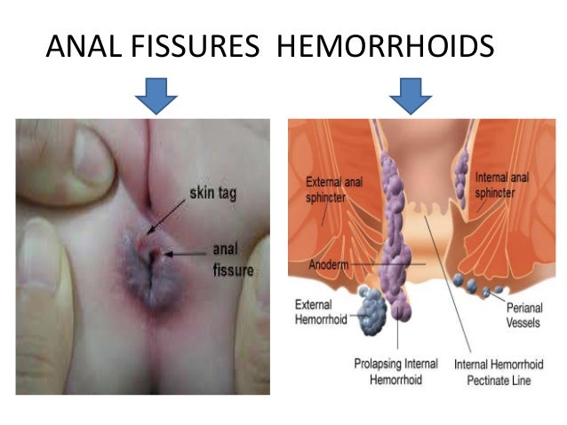 Anal cancer symptons