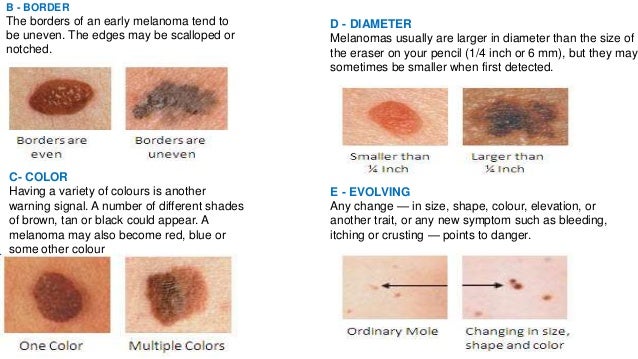 Home Treatment for Boils on Legs that Leave Ugly Marks