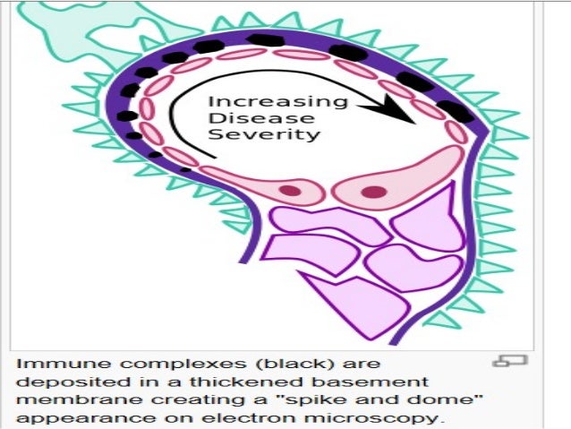Kidney disease Gn