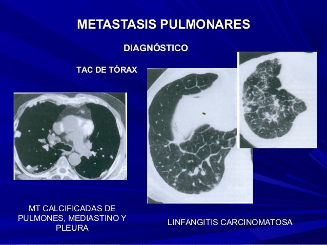 Metástasis Pleural