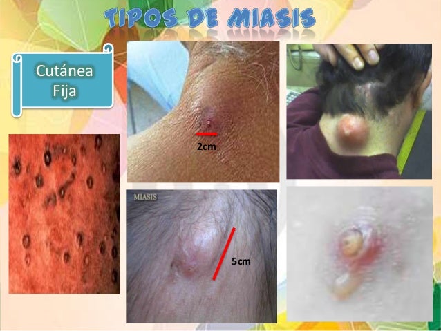 Miasis