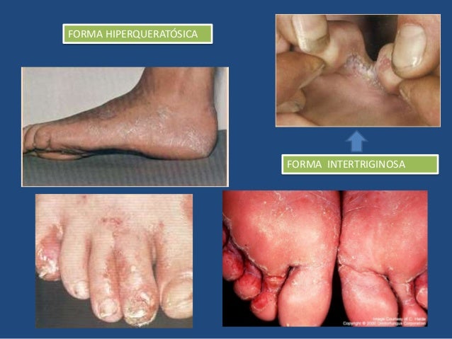 Las causas de la psoriasis de los niños