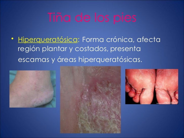 El vinagre de manzana para el hongo de las uñas en los pies