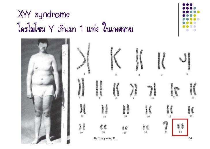 an overview of the genetic disorder klinefelters syndrome Klinefelter syndrome (ks): overview nichdnihgov eunice article/klinefelters-syndrome-xxy hhv8) kartagener syndrome , a genetic disorder. an overview of the genetic disorder klinefelters syndrome Klinefelter syndrome (ks): overview nichdnihgov eunice article/klinefelters-syndrome-xxy hhv8) kartagener syndrome , a genetic disorder.