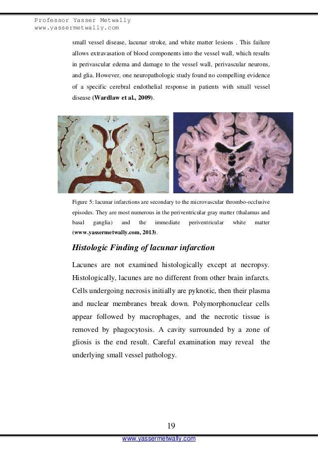 Supratentorial chronic microvascular ischemic white matter disease