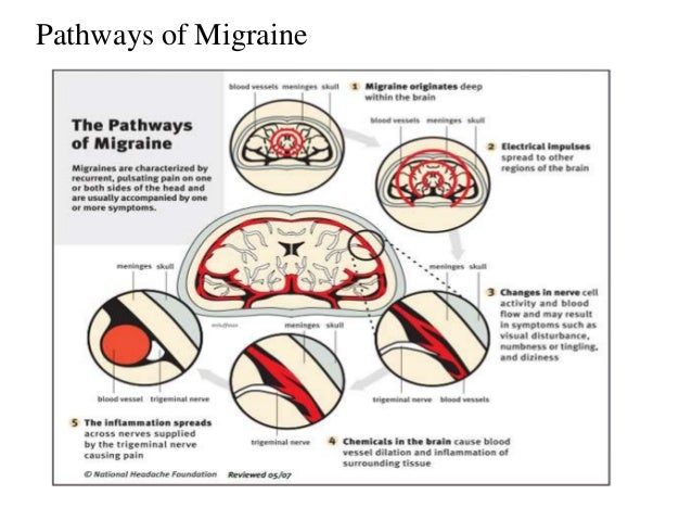 classical migraine - General Practice Notebook
