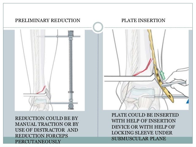 what is plate osteosynthesis Osteosynthesis: a surgical procedure that stabilizes and joins the ends of fractured (broken) bones by mechanical devices such as metal plates, pins, rods, wires or. what is plate osteosynthesis Osteosynthesis: a surgical procedure that stabilizes and joins the ends of fractured (broken) bones by mechanical devices such as metal plates, pins, rods, wires or.