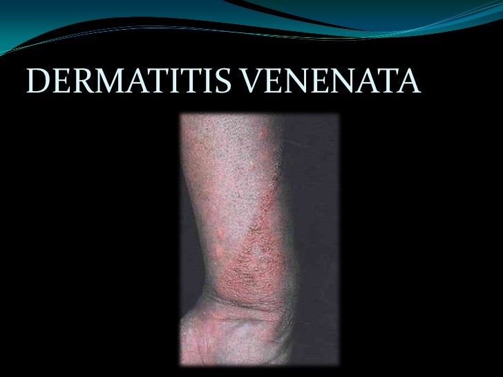 La eccema venosa de las venas