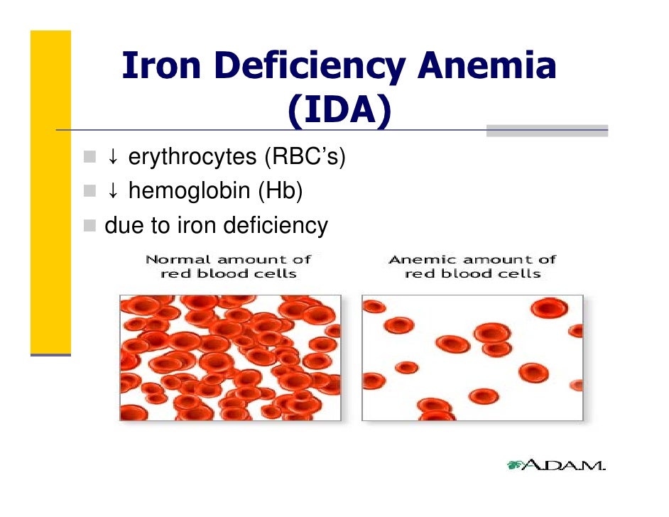 pediatric iron deficiency anemia case study The case study method of teaching applied to college science teaching a case of iron deficiency anemia author: david f dean department of biology. pediatric iron deficiency anemia case study The case study method of teaching applied to college science teaching a case of iron deficiency anemia author: david f dean department of biology.