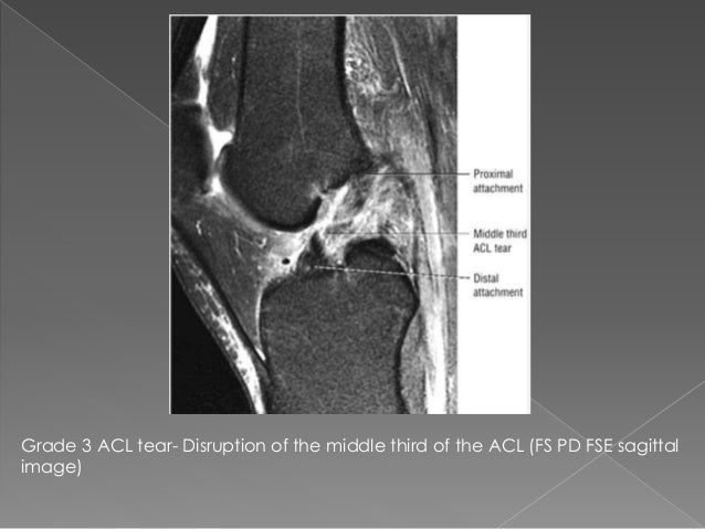 Controversies in knee rehabilitation anterior cruciate ligament injury anterior cruciate ligament damage induced by using internal tibial torsion or tibiofemoral compression