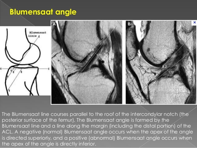Knee ultrasound acl torn ligament si joint