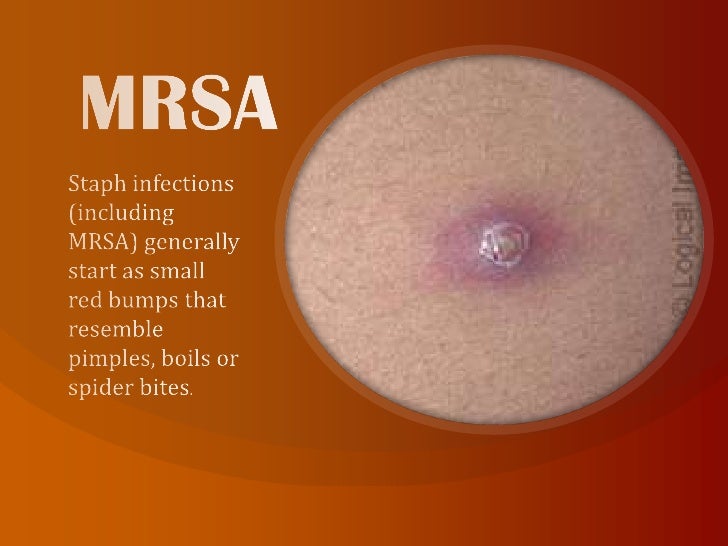MRSA Pictures: What Does MRSA Look Like on Skin?