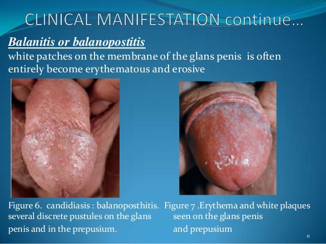 Recurrent male yeast infections