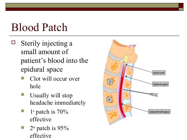 Spinal Tap Headache Blood Patch