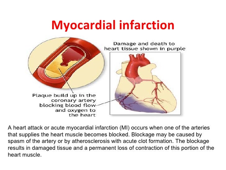 most likely source to cause pica artery infarction