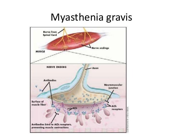 Myasthenia Gravis Definition