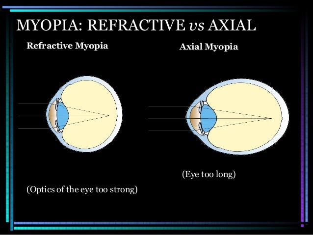 degenerative myopia bilateral degenerative myopia bilateral