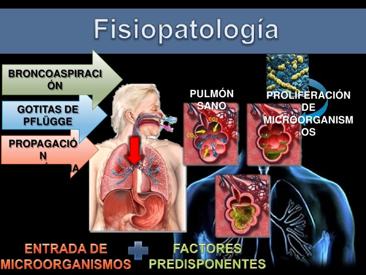 Neumonia adquirida en la comunidad