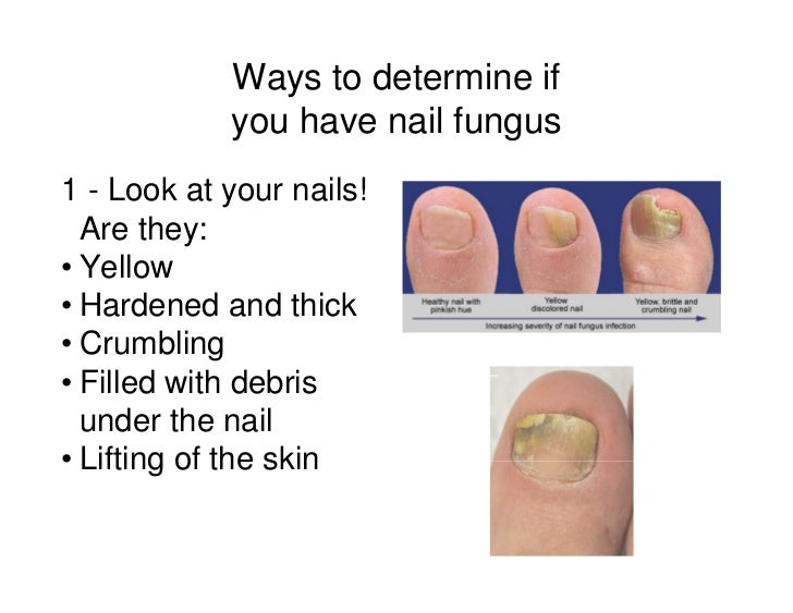 will lamisil cure toenail fungus