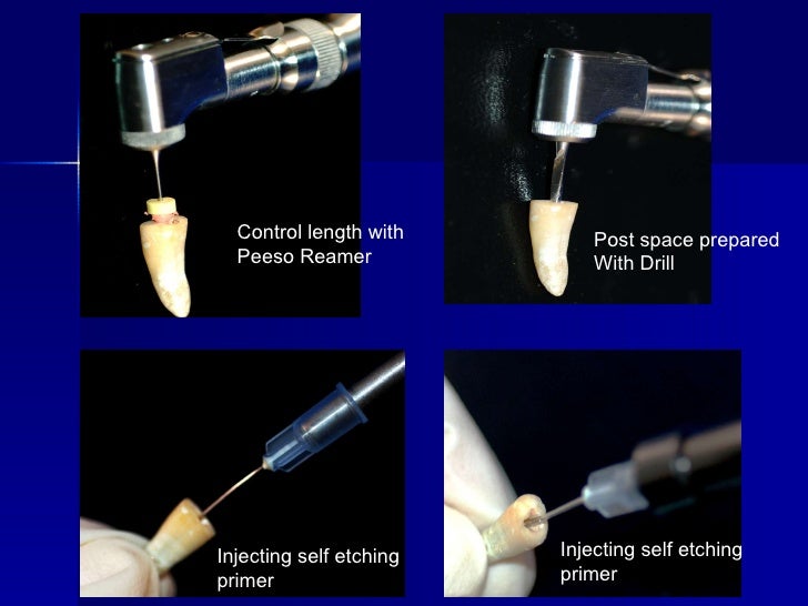 Endodontic Sealers