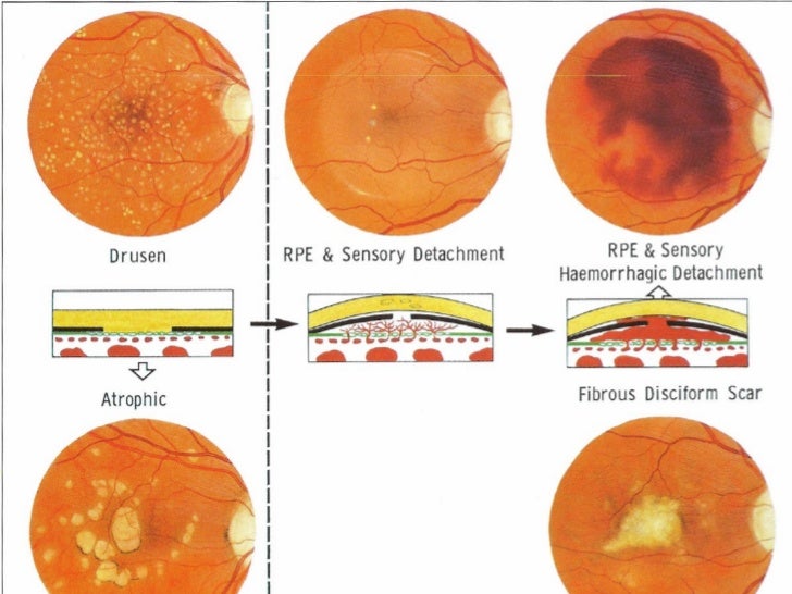 Macular Degeneration