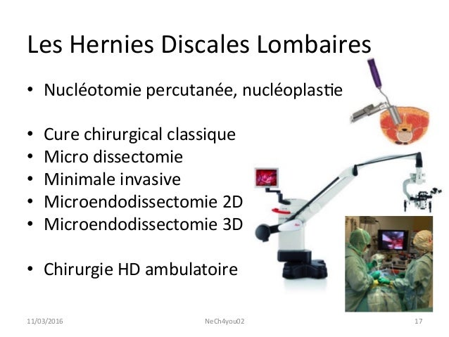 Tumeur Intramédullaire