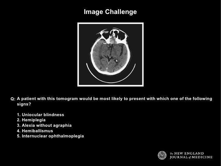 symptoms of a stroke in a toddler