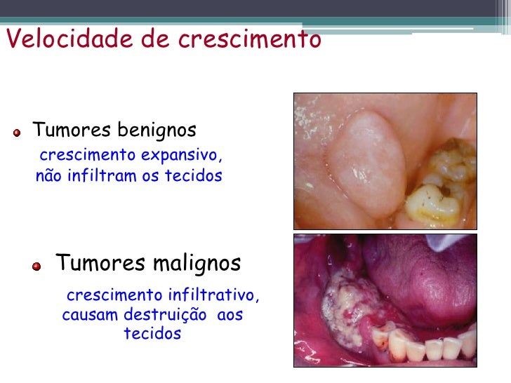 Metastase Vias De Disseminação