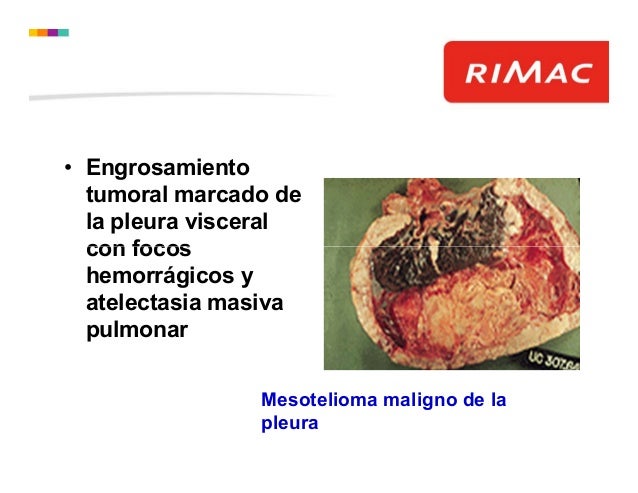 Mesotelioma Maligno Historia Natural