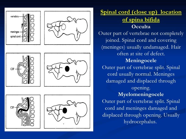 neural tube defect