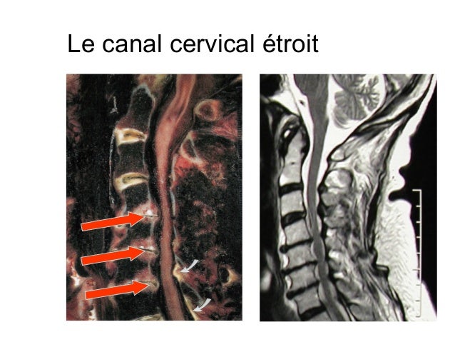 La culture physique après lopération sur le service cervical de lépine dorsale