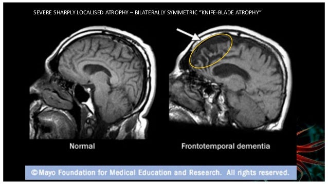 ct scan vs mri