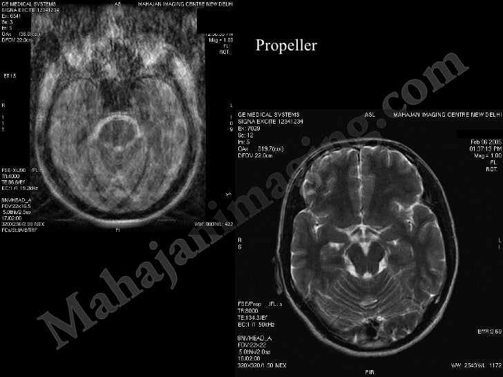 Small students stroke stroke management in india