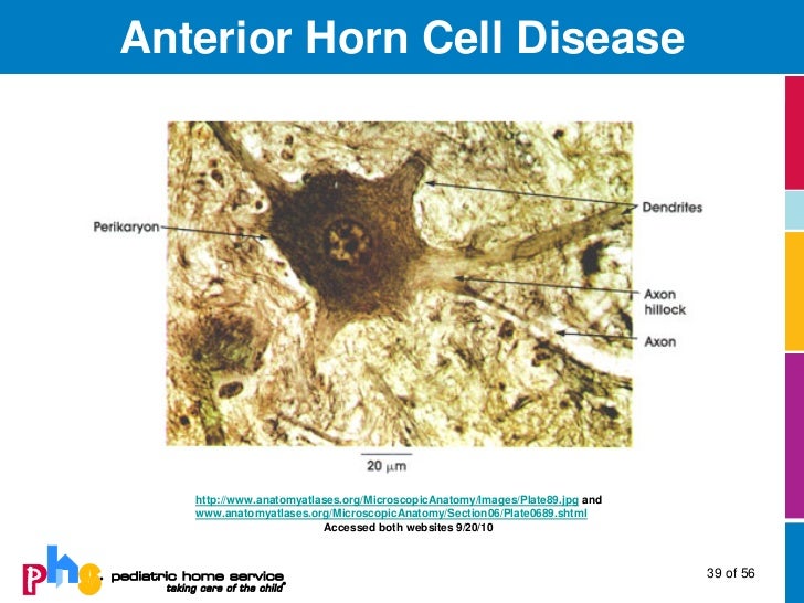 Anterior horn disease