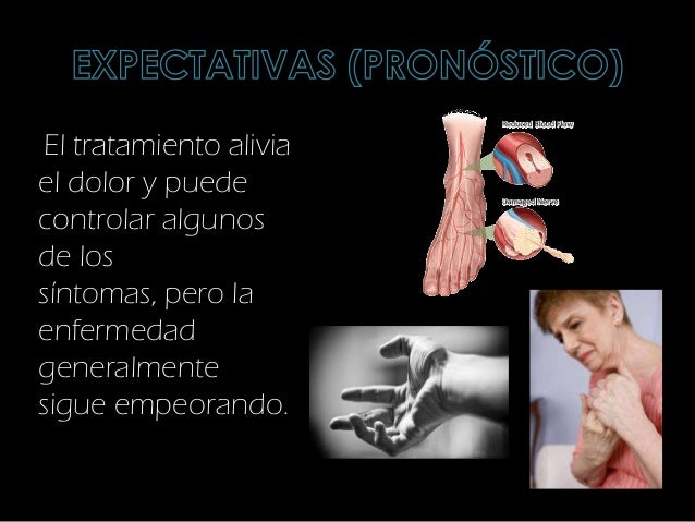 Neuropatía diabética Neuropatía diabética