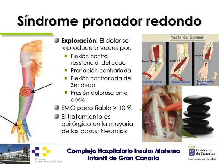 Neuropatías por atrapamiento de miembro superior