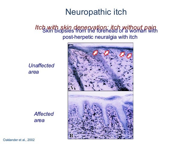 neuropathic itch