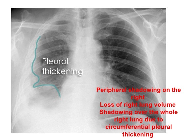 treatment for asbestosis mesothelioma alliance