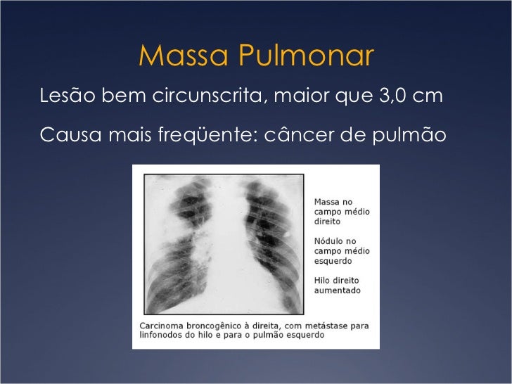 Aula 3: Nódulos e Massas Pulmonares