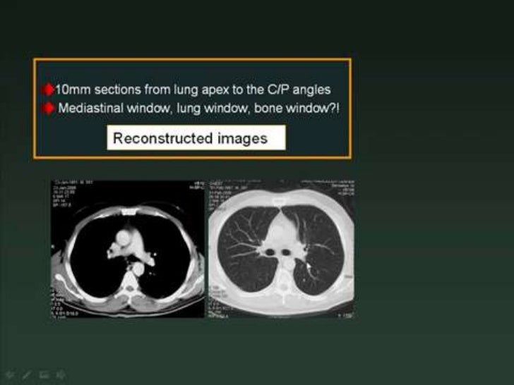 normal chest ct lung window