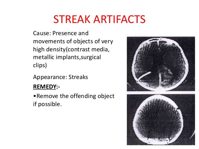 motion artifact meaning