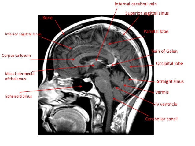 sinus headache or mind tumor sinus headache while on antibiotics