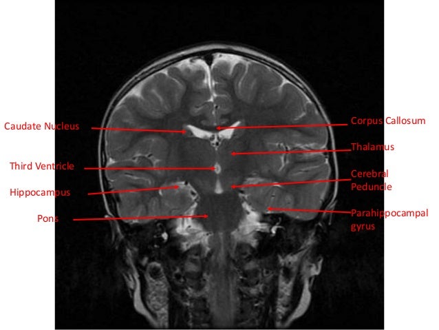 reasons of sinus venous thrombosis