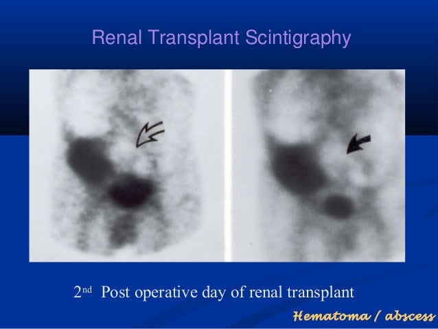Kidney transplant age dialysis treatment headaches