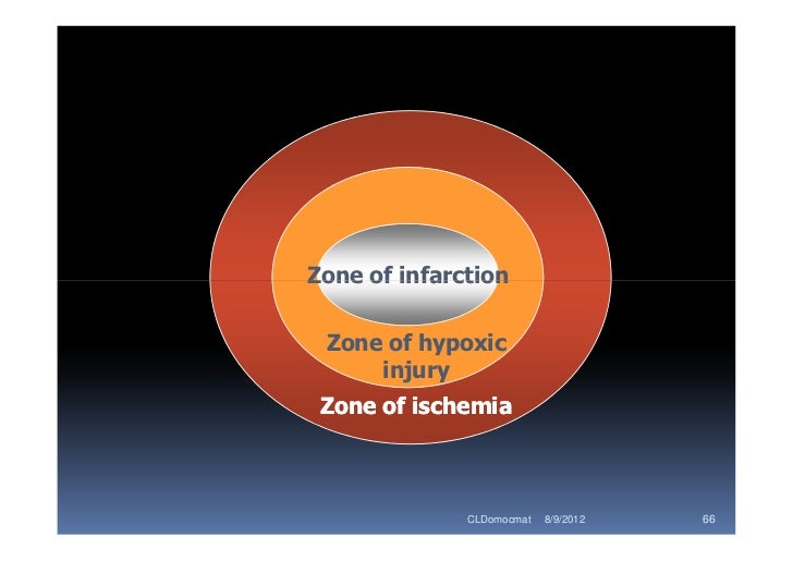 MI effects on tissue Coronary artery disease, Hypoxic