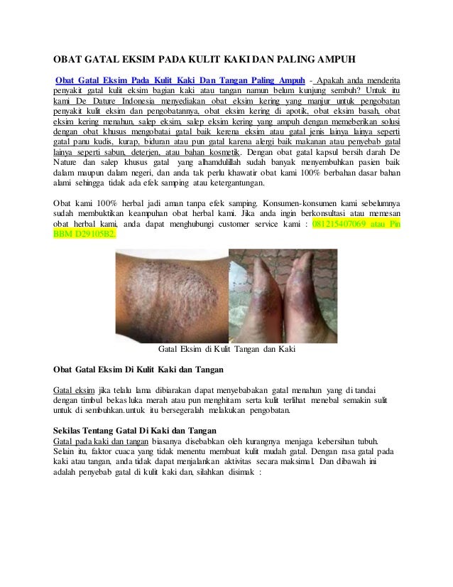 obat gatal eksim pada kulit kaki dan tangan paling uh obat gatal eksim pada kulit kaki dan tangan paling uh