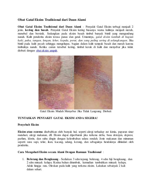 obat gatal eksim tradisional dari daun alami obat gatal eksim tradisional dari daun alami