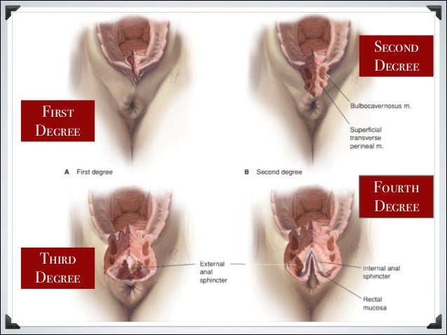 Episiotomy - Wikipedia