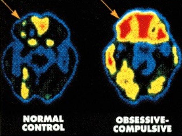 Obsessive compulsive disorder essay conclusion